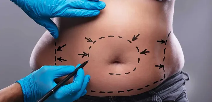 Liposuccion Douce Avis: Le Moyen Simple Et Rapide D'Éliminer La Graisse 3 liposuccion douce avis